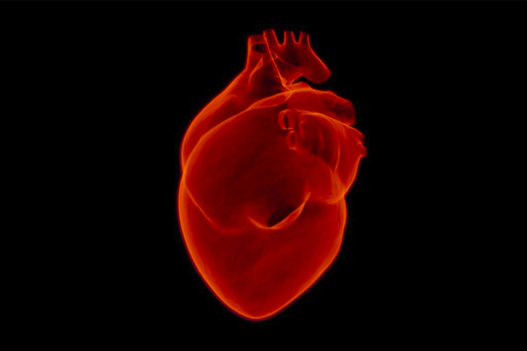infarto-miocardio
